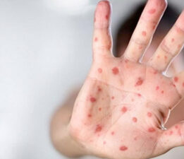 İletişim Başkanlığı, ‘maymun çiçeği’ hastalığına ilişkin merak edilen soru ve yanıtları yayımladı